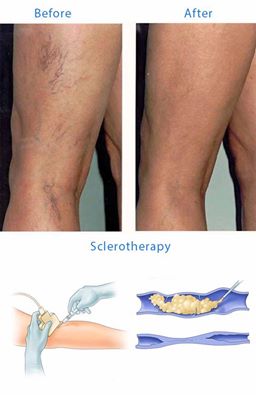 #‎Sclerotherapy‬ is a medical procedure used to eliminate varicose veins and spider veins. Sclerotherapy involves an injection of a solution (generally a salt solution) directly into the vein. The solution irritates the lining of the blood vessel, causing it to swell and stick together, and the blood to clot. Call 910-491-1760 for a complimentary consultation. ‪#‎spiderveins‬ ‪#‎spiderveinsremoval‬ ‪#‎imagespamd‬ ‪#‎imagepspamdmakeover‬ ‪#‎healthandbeauty‬ ‪#‎medspa‬ ‪#‎ranchocucamonga‬ ‪#‎encinitas‬ ‪#‎beverlyblvd‬ ‪#‎ca‬ ‪#‎beforeandafter‬ 