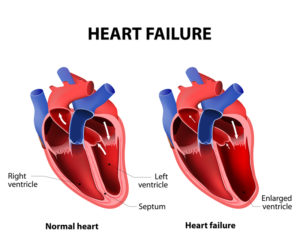 Congestive Heart Failure diagram